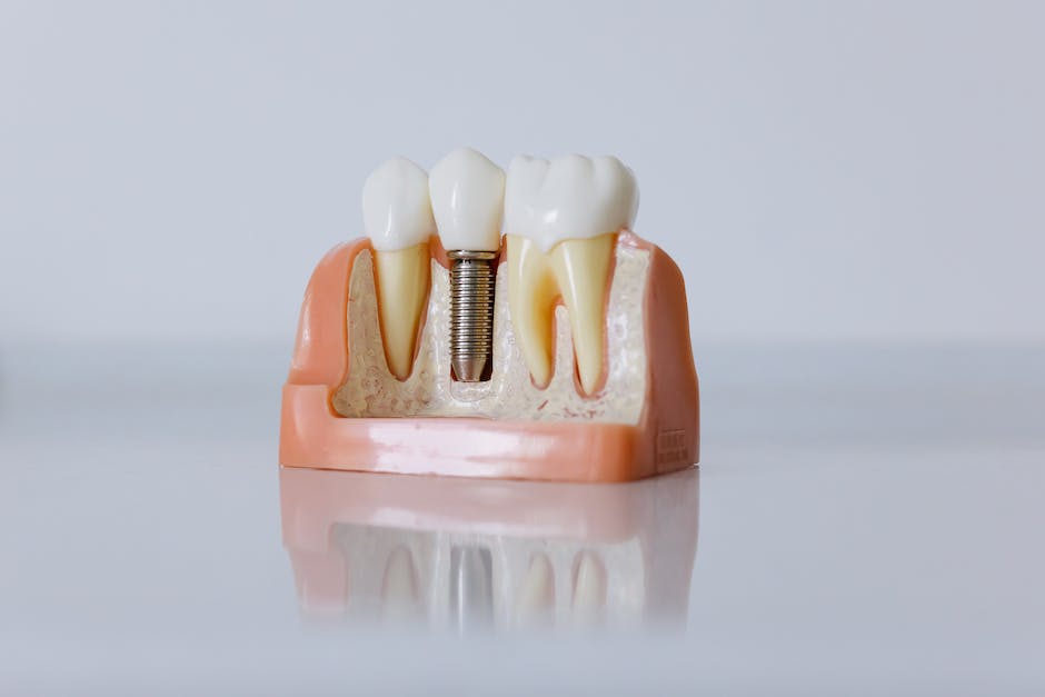 Dental implant model showing a screw in the jawbone with surrounding teeth.