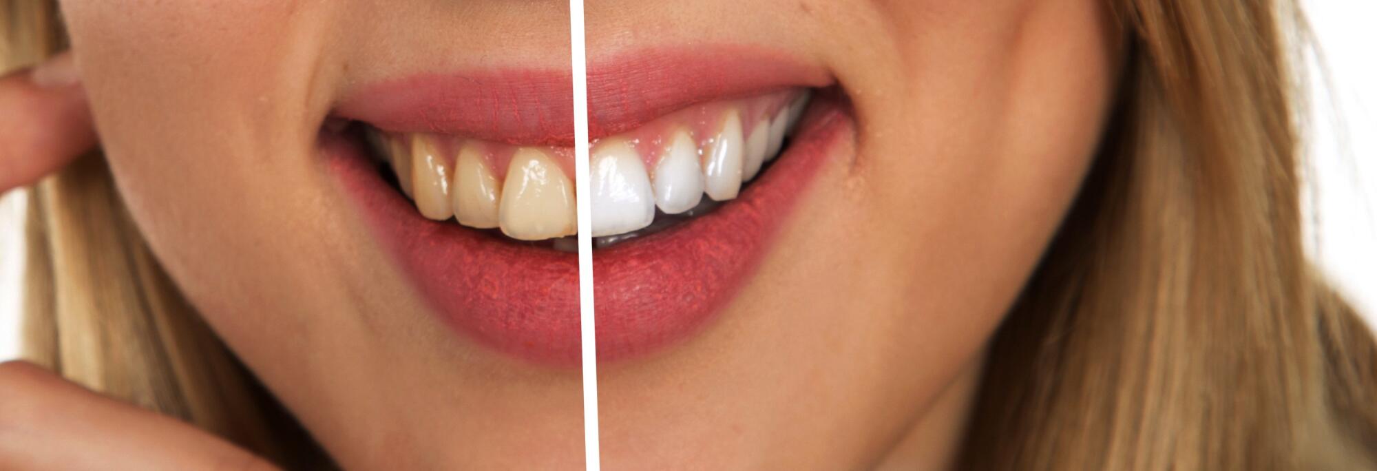 Woman smile with and without smoke stains