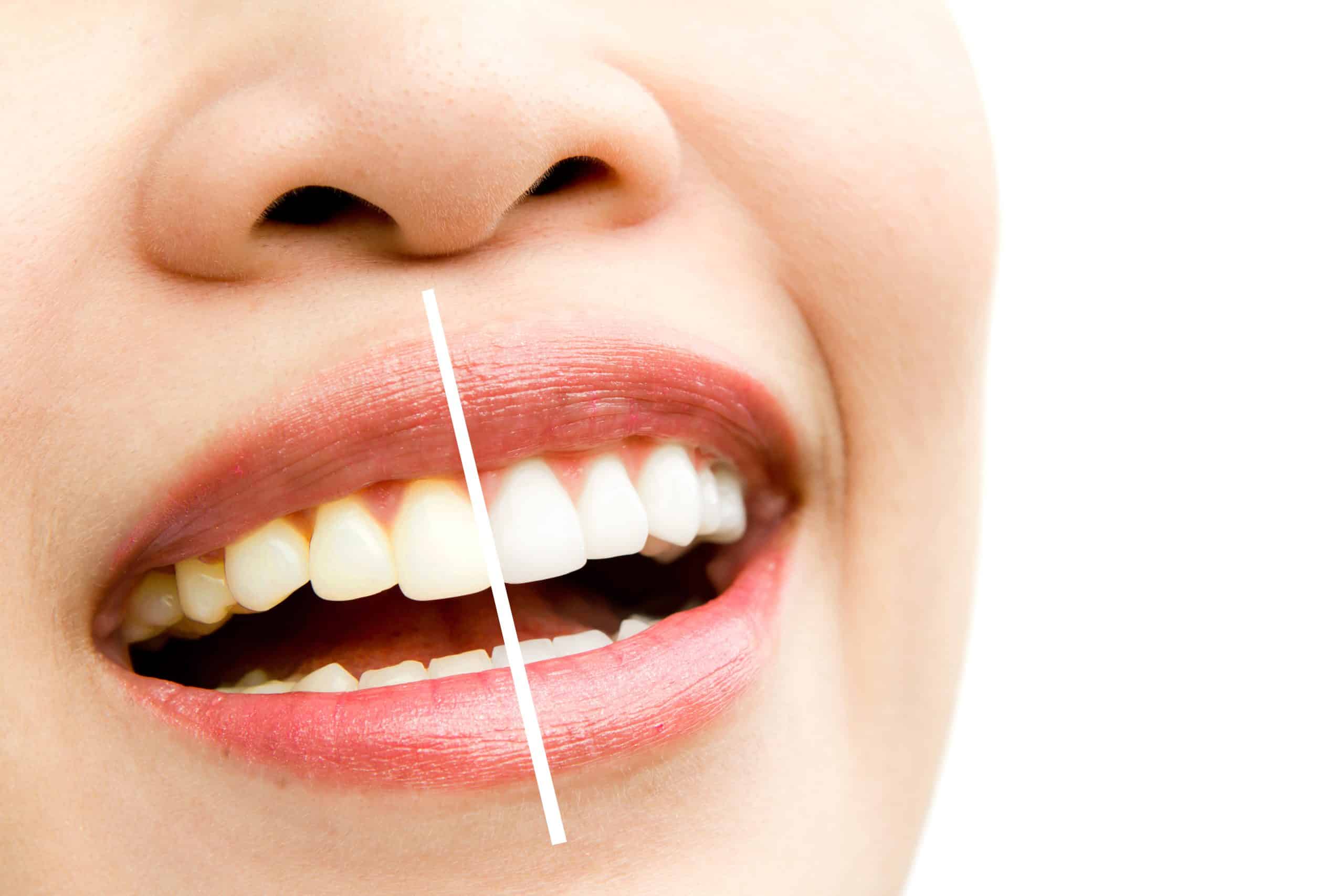 Woman with old smile with darker teeth showing next to a whitened smile